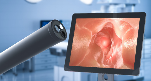 Stock photograph portraying a colonoscope and a digital monitor displaying the inside of a patient’s colon as viewed through the colonoscope.